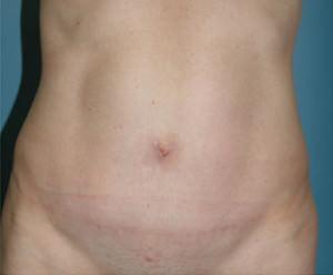 New York Plastic Surgery tummy tuck after — New York, NY
