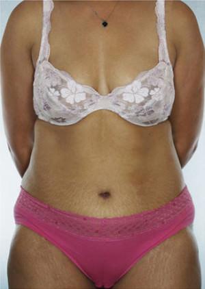 New York Plastic Surgery tummy tuck after — New York, NY
