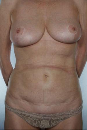 New York Plastic Surgery tummy tuck after — New York, NY