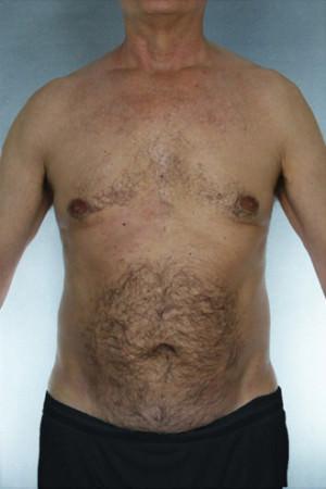 New York Plastic Surgery liposuction after — New York, NY
