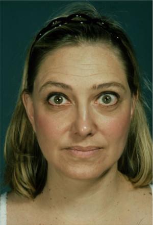 New York Plastic Surgery facelift after — New York, NY