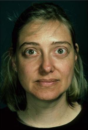 Brow Lift before at New York Plastic Surgery in New York, NY