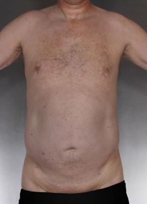 New York Plastic Surgery liposuction after — New York, NY