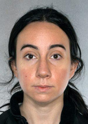 New York Plastic Surgery rhinoplasty after — New York, NY