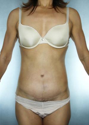New York Plastic Surgery tummy tuck after — New York, NY