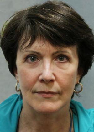 New York Plastic Surgery facelift after — New York, NY