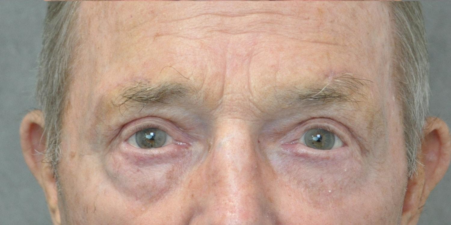 David Isaacs, MD eyelid lift after — Beverly Hills, CA