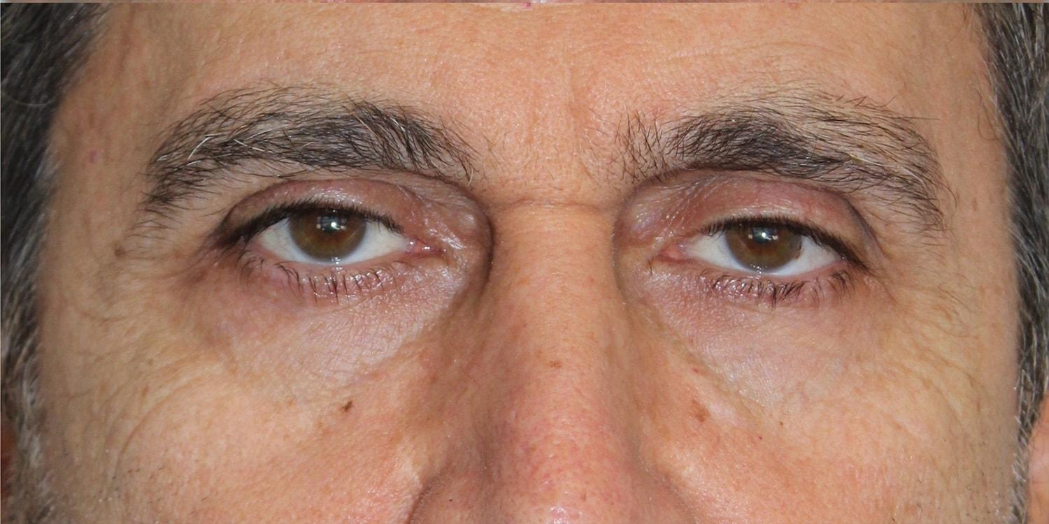 David Isaacs, MD eyelid lift after — Beverly Hills, CA