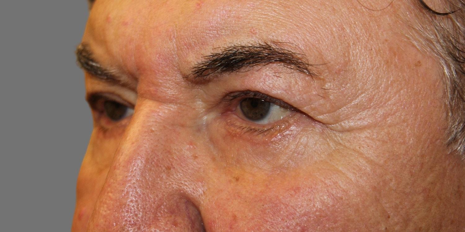 David Isaacs, MD eyelid lift after — Beverly Hills, CA
