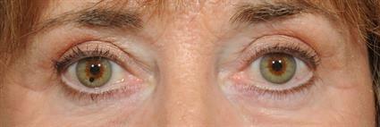 Belage Cosmetic Surgery Center eyelid lift after — Houston, TX