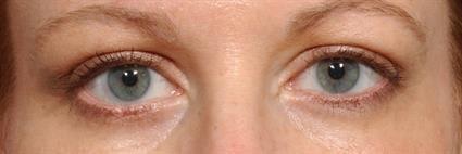 Belage Cosmetic Surgery Center eyelid lift after — Houston, TX