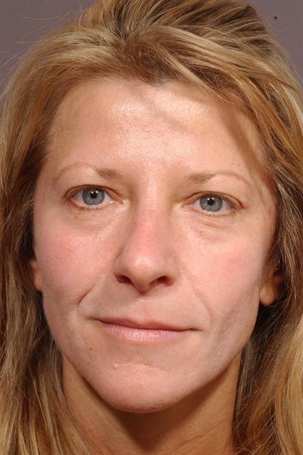 Brow Lift before at Belage Cosmetic Surgery Center in Houston, TX