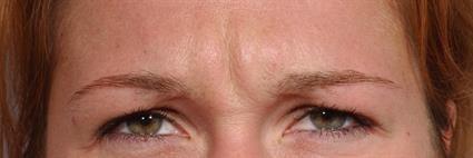Botox before at Belage Cosmetic Surgery Center in Houston, TX
