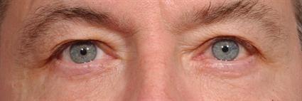 Belage Cosmetic Surgery Center eyelid lift after — Houston, TX
