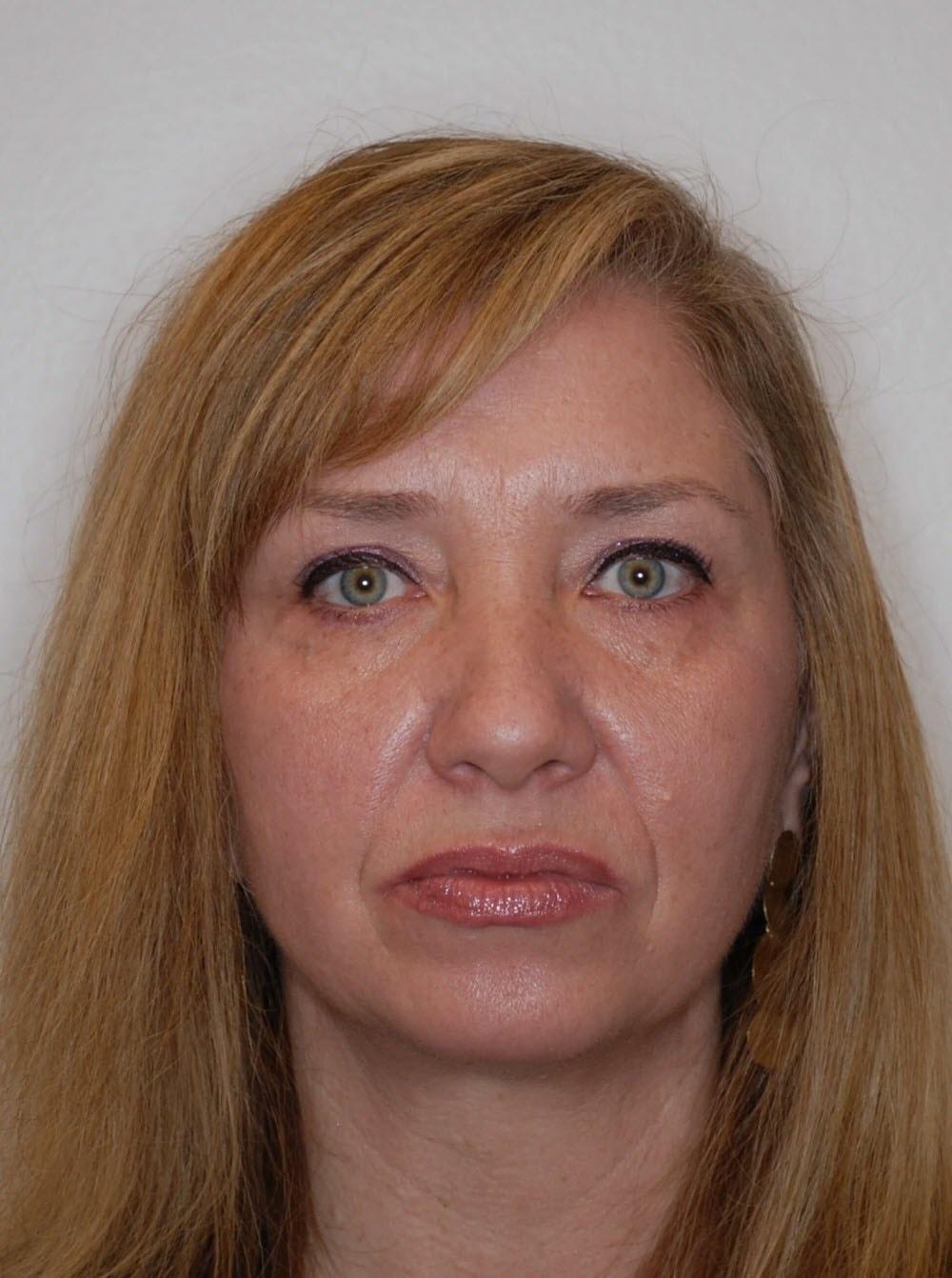 Belage Cosmetic Surgery Center morpheus8 after — Houston, TX