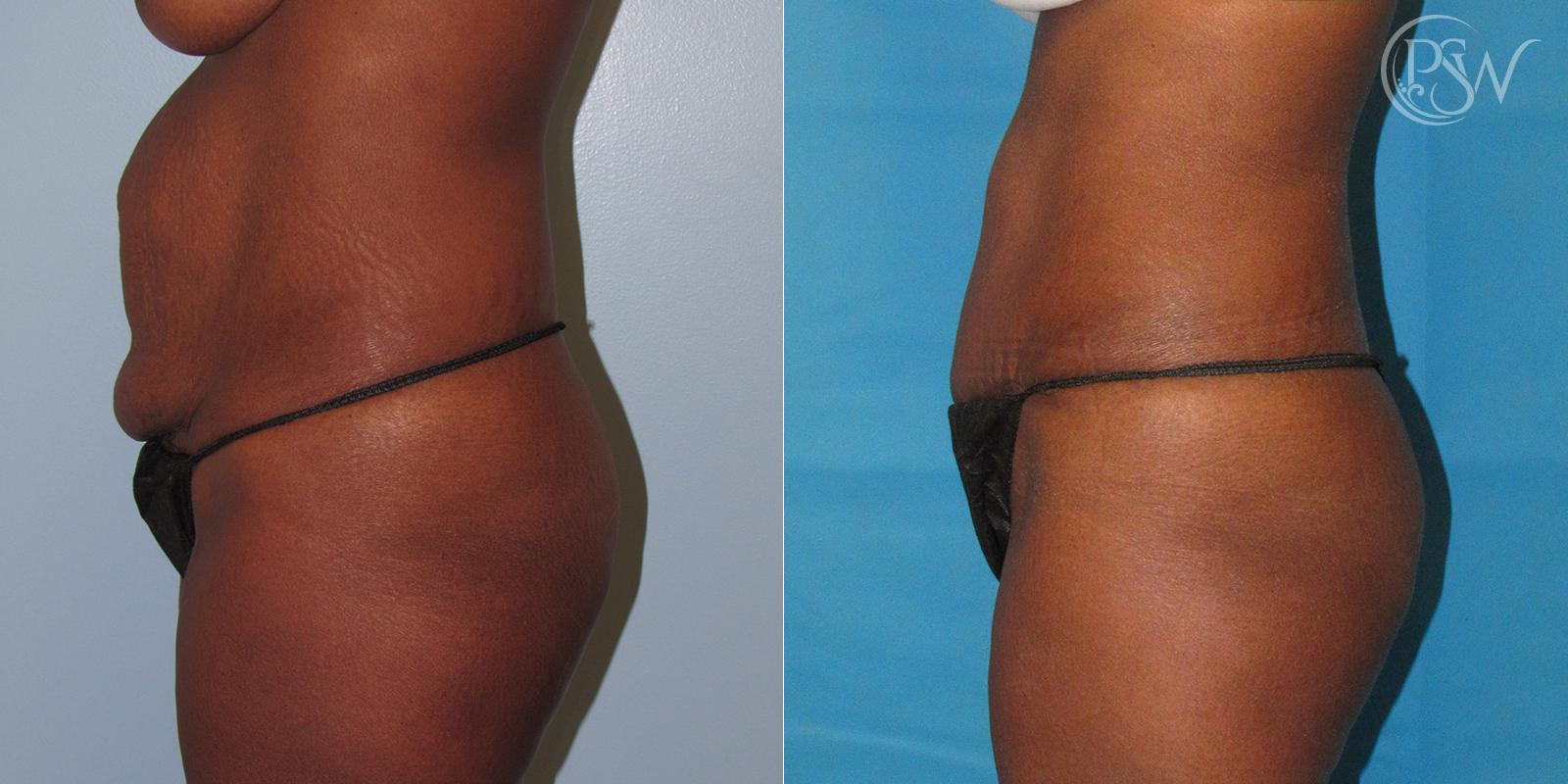 Plastic Surgery Group (PSW) tummy tuck result — Albany, NY