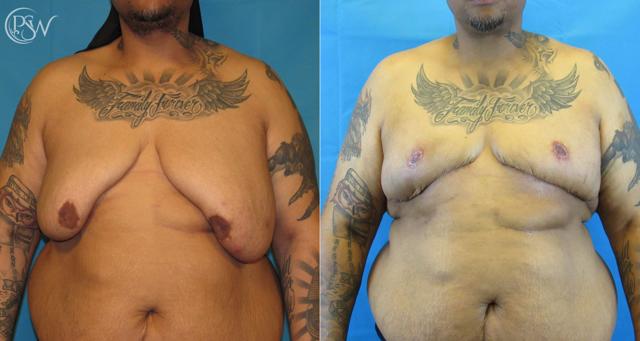 Gynecomastia Surgery result at Plastic Surgery Group (PSW) in Albany, NY