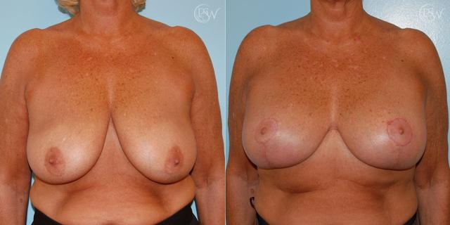 Breast Lift result at Plastic Surgery Group (PSW) in Albany, NY