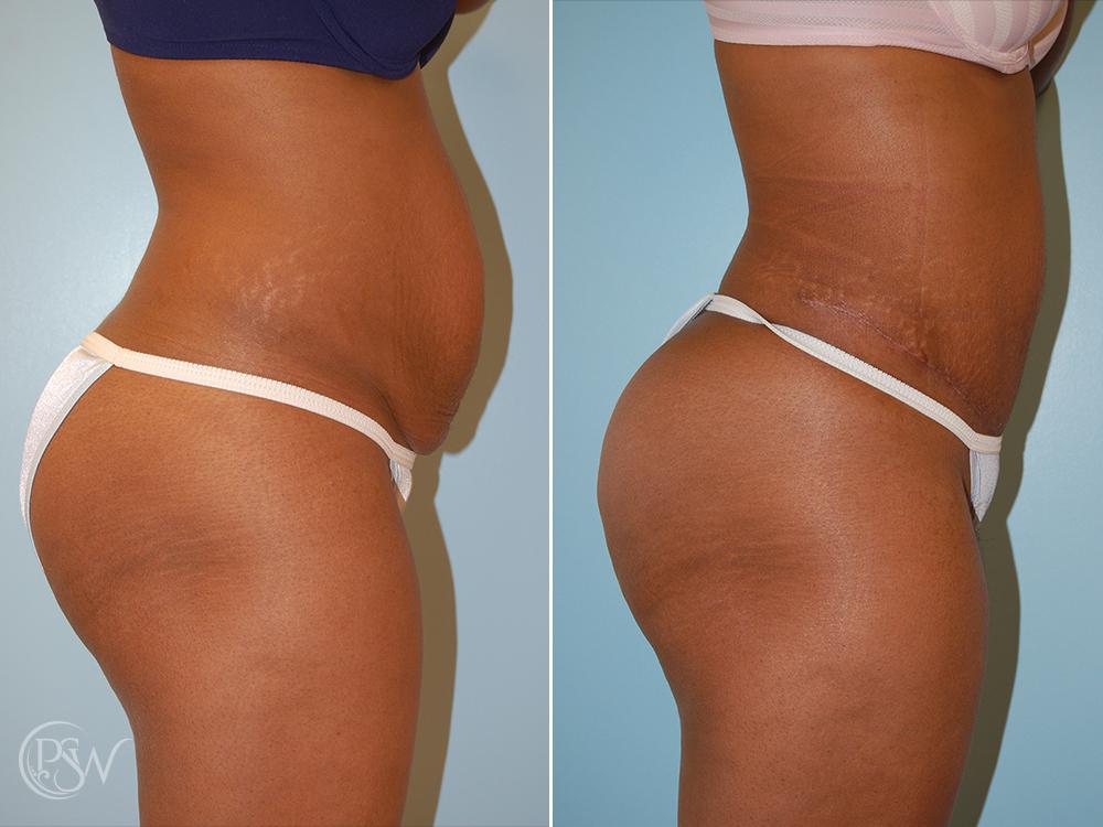 Plastic Surgery Group (PSW) tummy tuck result — Albany, NY