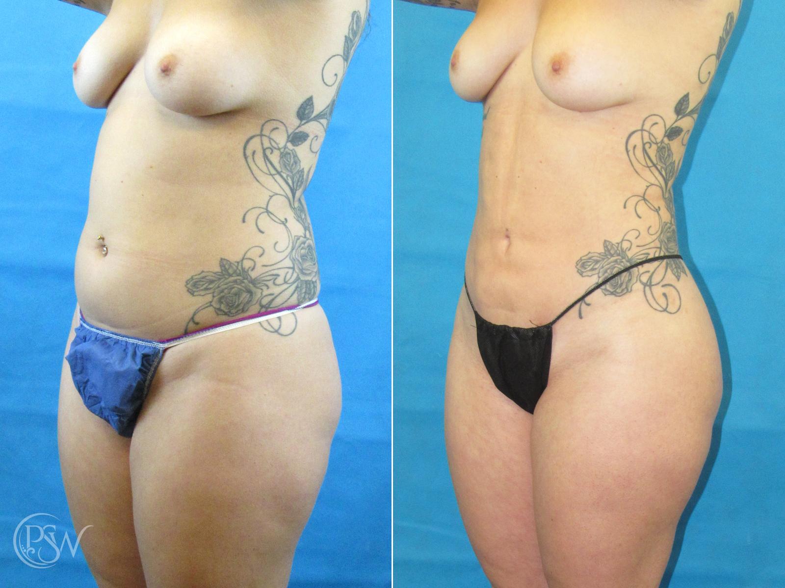 Plastic Surgery Group (PSW) tummy tuck result — Albany, NY