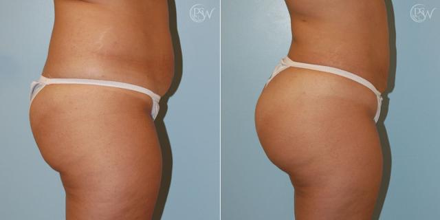Brazilian Butt Lift result at Plastic Surgery Group (PSW) in Albany, NY