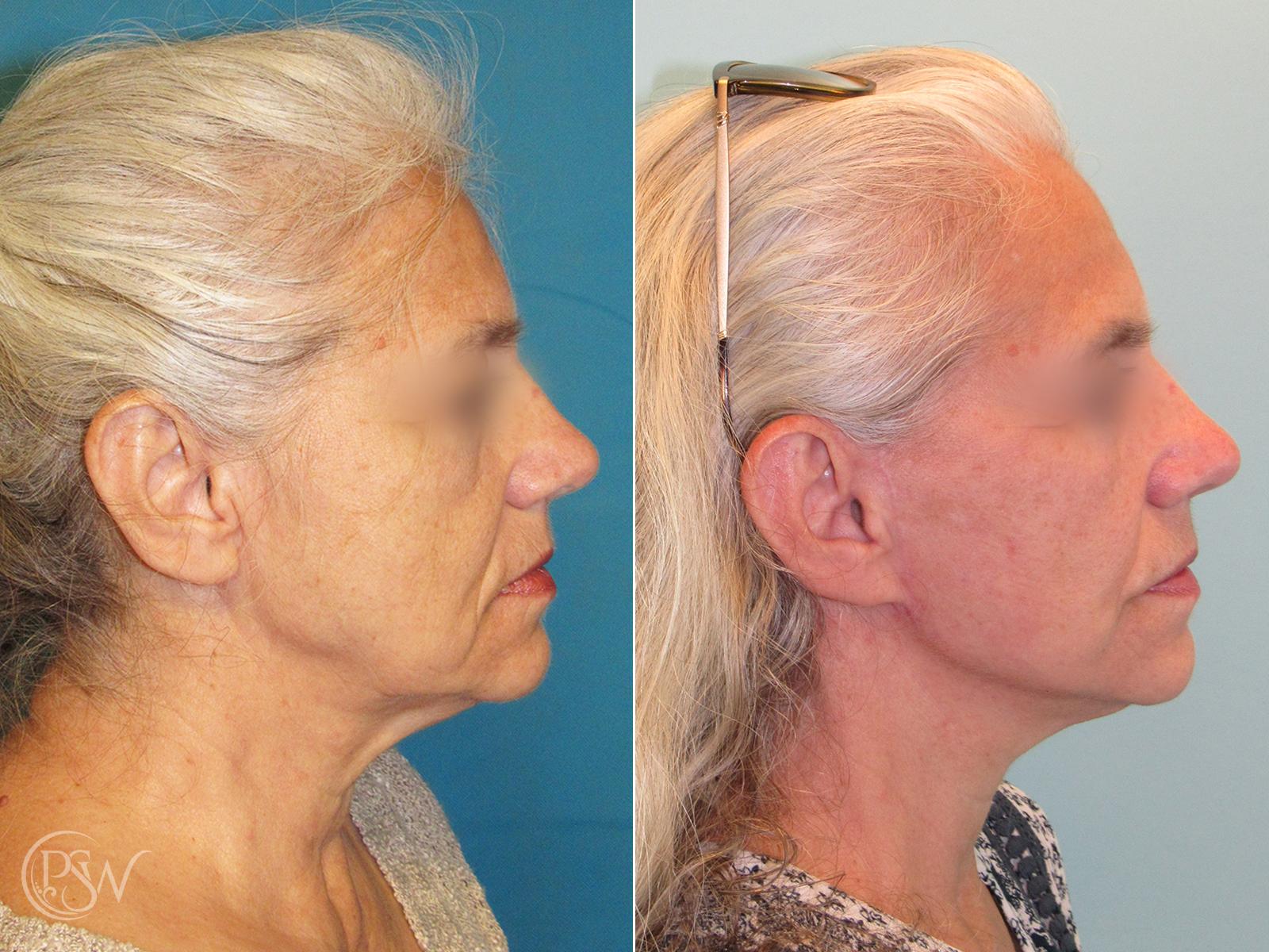 Plastic Surgery Group (PSW) facelift result — Albany, NY