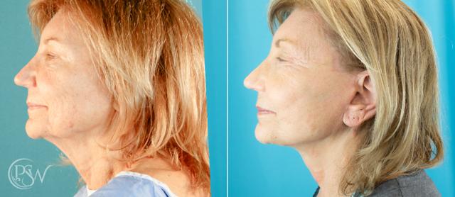Neck Lift result at Plastic Surgery Group (PSW) in Albany, NY
