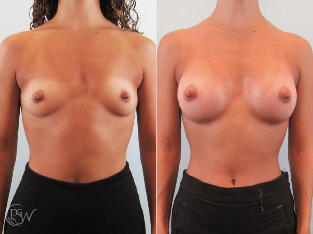 Breast Augmentation result at Plastic Surgery Group (PSW) in Albany, NY