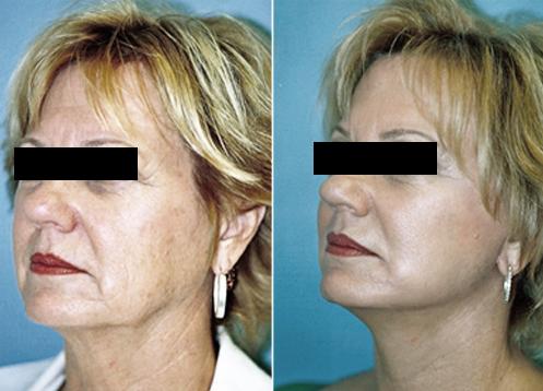 Plastic Surgery Group (PSW) facelift result — Albany, NY