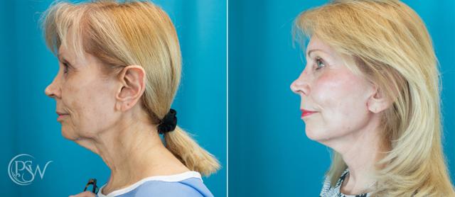 Neck Lift result at Plastic Surgery Group (PSW) in Albany, NY