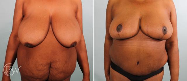 Mommy Makeover result at Plastic Surgery Group (PSW) in Albany, NY