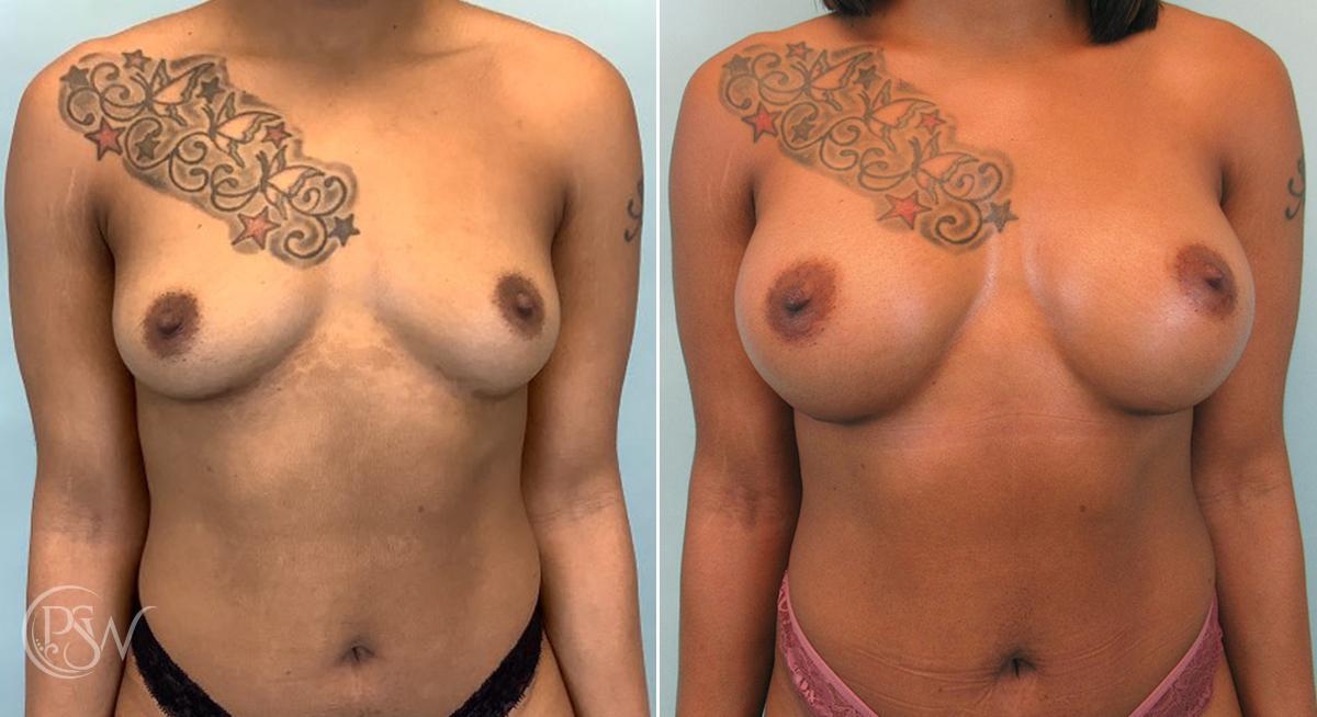 Plastic Surgery Group (PSW) breast augmentation result — Albany, NY