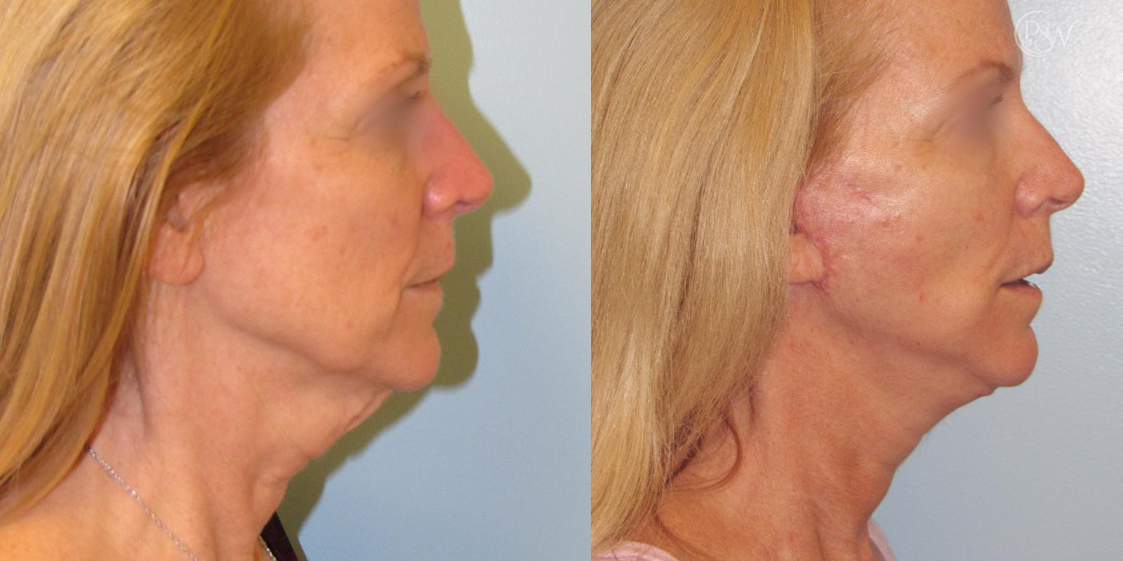 Plastic Surgery Group (PSW) facelift result — Albany, NY