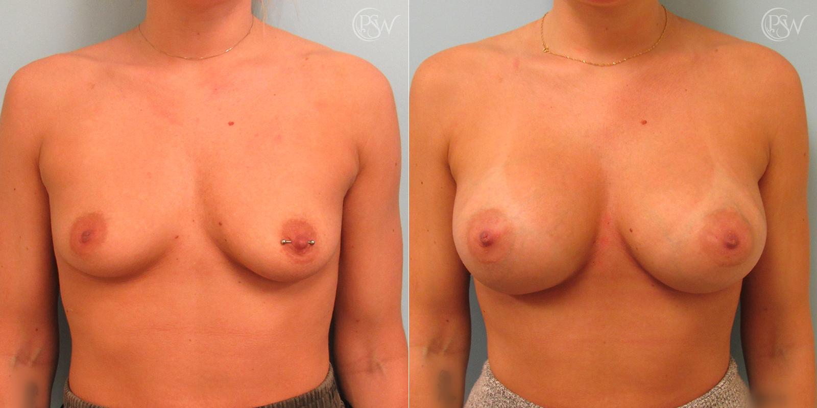 Plastic Surgery Group (PSW) breast lift result — Albany, NY