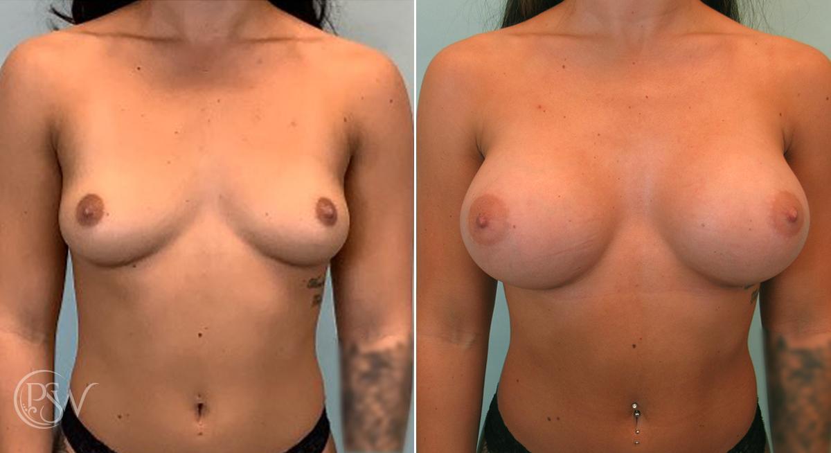 Plastic Surgery Group (PSW) breast augmentation result — Albany, NY