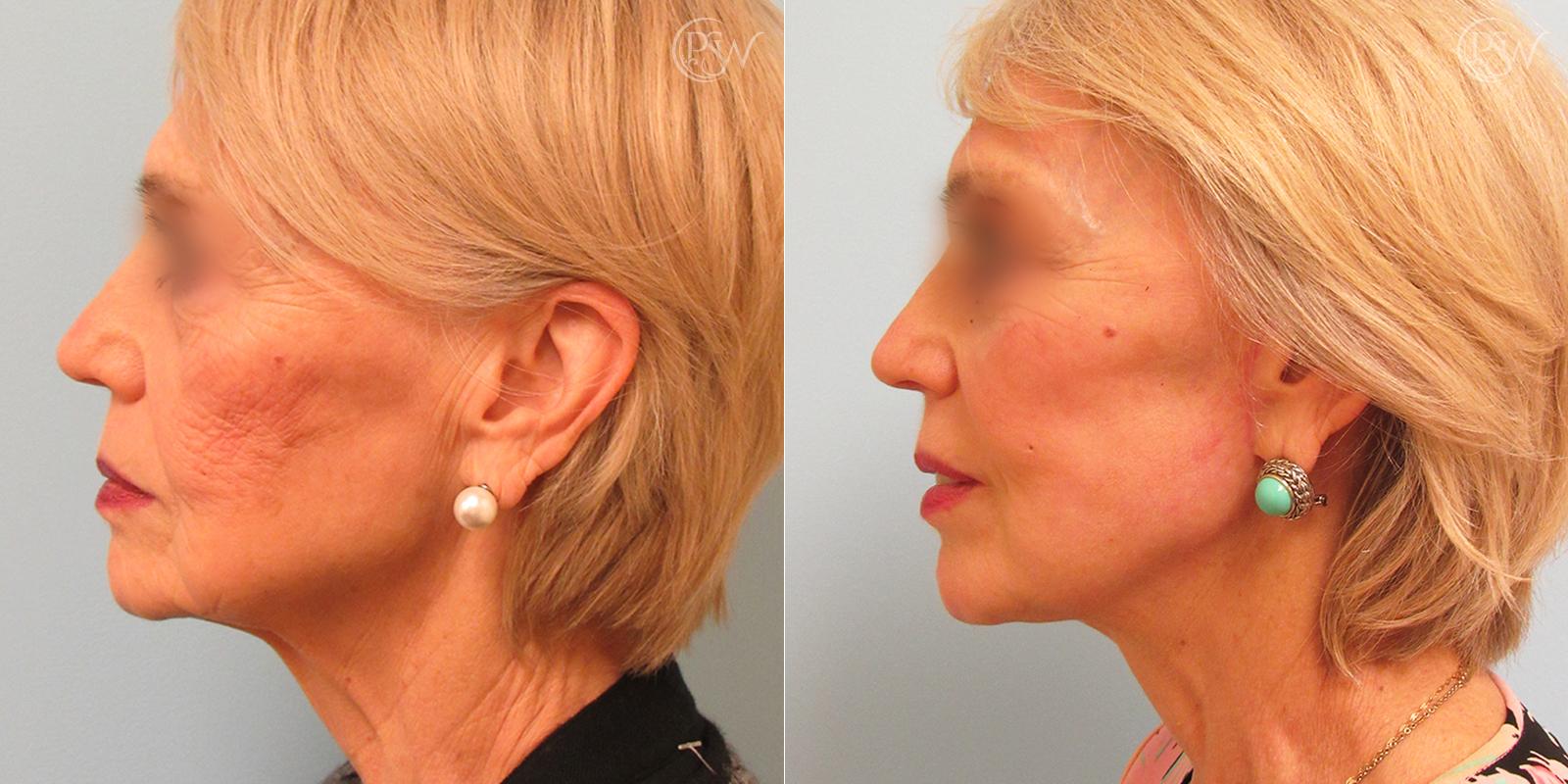 Plastic Surgery Group (PSW) facelift result — Albany, NY