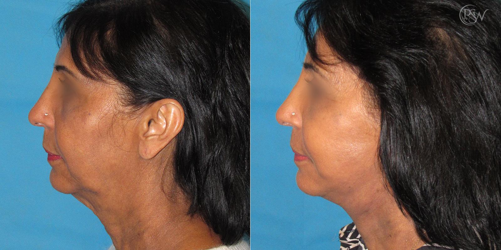 Plastic Surgery Group (PSW) facelift result — Albany, NY