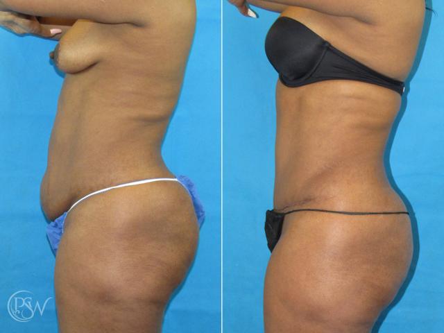 Tummy Tuck result at Plastic Surgery Group (PSW) in Albany, NY