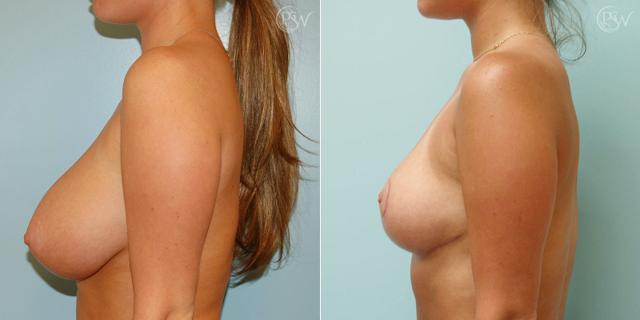 Breast Reduction result at Plastic Surgery Group (PSW) in Albany, NY