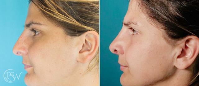 Rhinoplasty result at Plastic Surgery Group (PSW) in Albany, NY