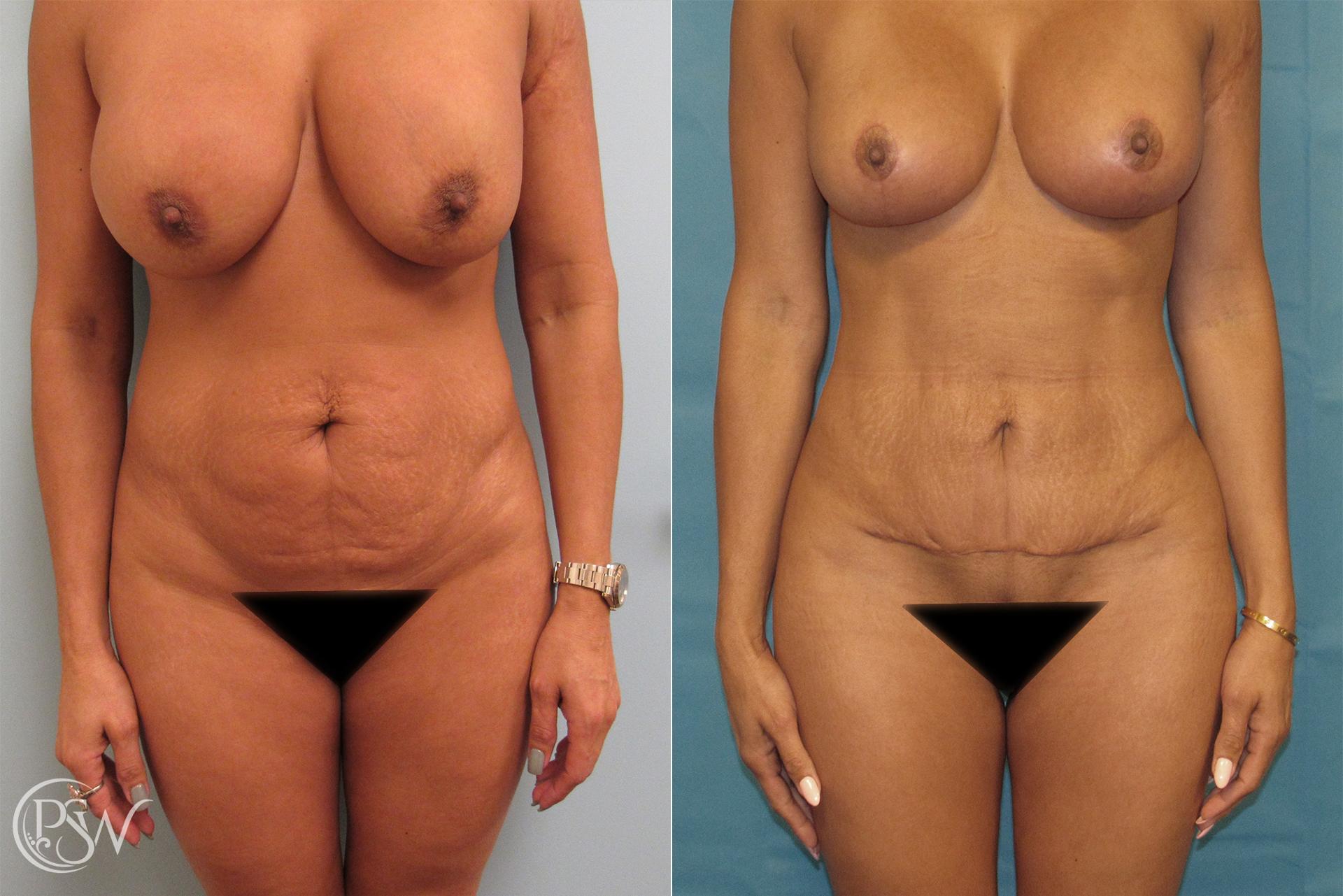 Plastic Surgery Group (PSW) tummy tuck result — Albany, NY