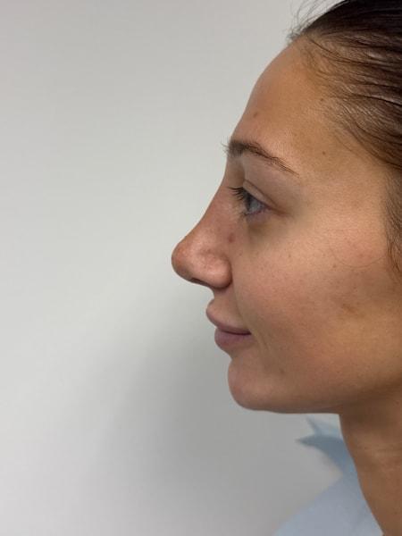 Plastic Surgery Specialists of New Jersey rhinoplasty after — Paramus, NJ