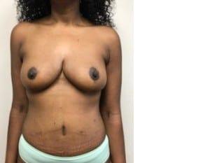 Plastic Surgery Specialists of New Jersey breast lift after — Paramus, NJ