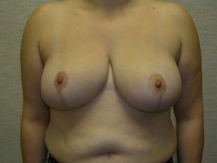 Plastic Surgery Specialists of New Jersey breast reduction after — Paramus, NJ