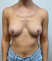 Plastic Surgery Specialists of New Jersey breast augmentation after — Paramus, NJ