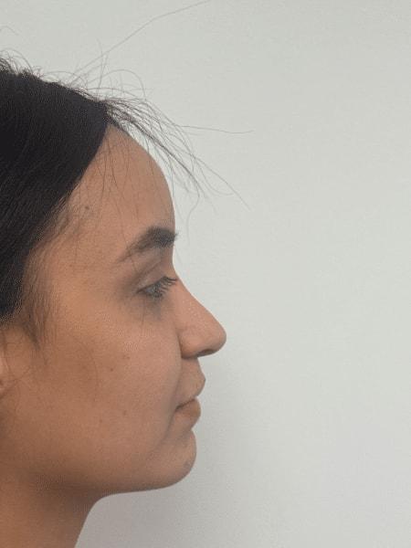 Plastic Surgery Specialists of New Jersey rhinoplasty after — Paramus, NJ