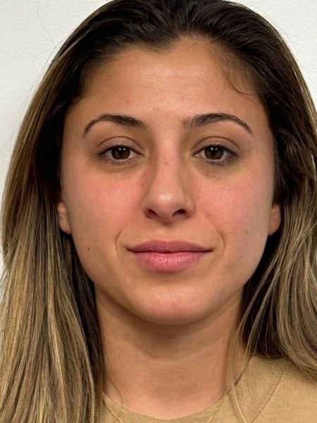 Plastic Surgery Specialists of New Jersey rhinoplasty after — Paramus, NJ