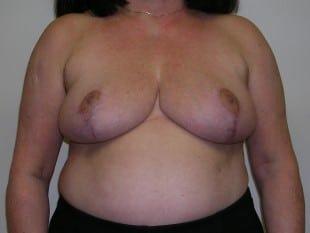 Plastic Surgery Specialists of New Jersey breast reduction after — Paramus, NJ