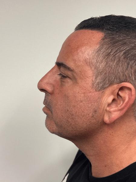 Plastic Surgery Specialists of New Jersey rhinoplasty after — Paramus, NJ