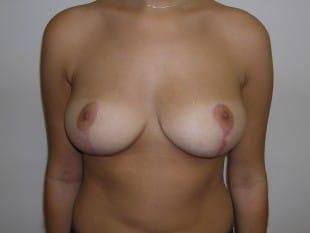 Plastic Surgery Specialists of New Jersey breast lift after — Paramus, NJ